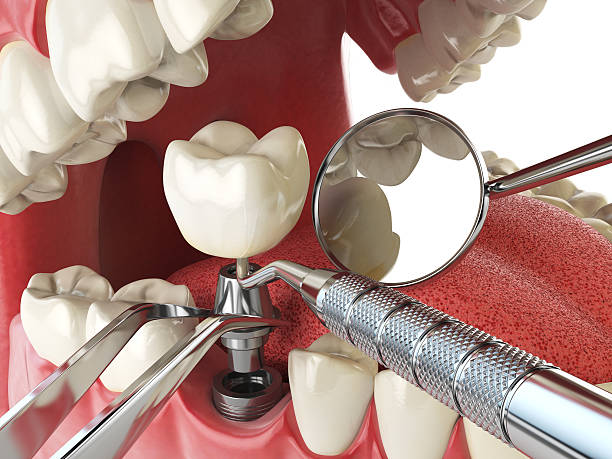 Best Weekend Emergency Dentist in Contra Costa Centre, CA